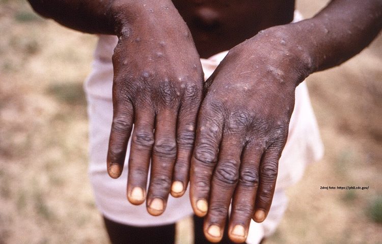 ilustračná fotografia: Monkeypox vírus (vírus „opičích kiahní“).