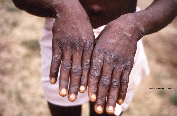 ilustračná fotografia: Monkeypox vírus (vírus „opičích kiahní“).